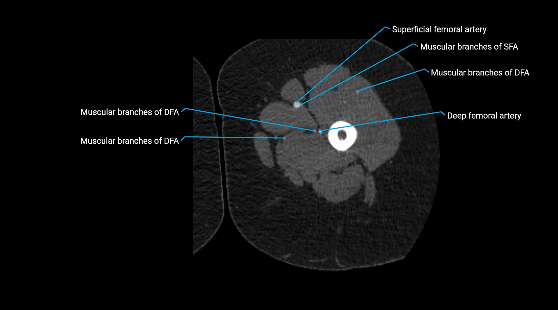 CTA lower limb cross sectional anatomy labelled image _104.webp